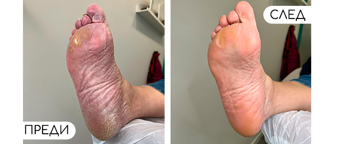 Медицински педикюр | ОРТОТЕХ ЦЕНА 02 Медицински педикюр | ОРТОТЕХ ЦЕНА 02