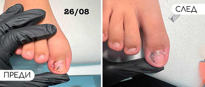 Медицински педикюр | ОРТОТЕХ ЦЕНА 03 Медицински педикюр | ОРТОТЕХ ЦЕНА 03