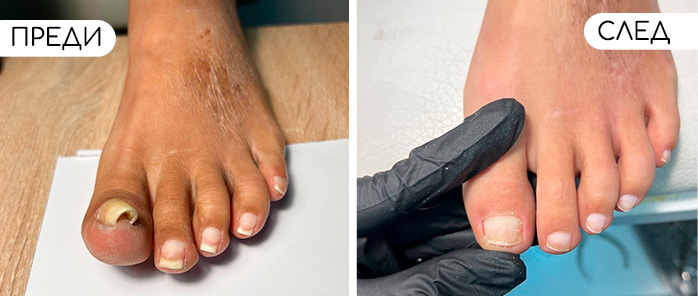 Медицински педикюр | ОРТОТЕХ ЦЕНА 04 Медицински педикюр | ОРТОТЕХ ЦЕНА 04