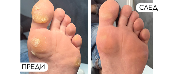 Медицински педикюр | ОРТОТЕХ ЦЕНА Медицински педикюр | ОРТОТЕХ ЦЕНА