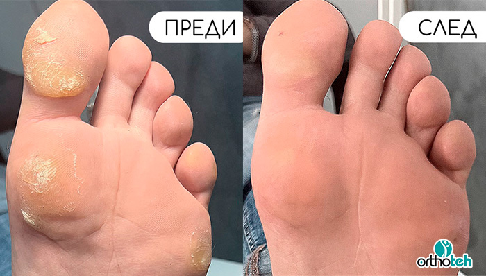 Терапевтичен педикюр | ОРТОТЕХ 03 Терапевтичен педикюр | ОРТОТЕХ 03