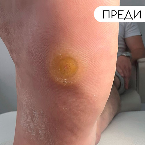 Премахване на кокоши трън | Медицински педикюр | ОРТОТЕХ 03 Премахване на кокоши трън | Медицински педикюр | ОРТОТЕХ 03