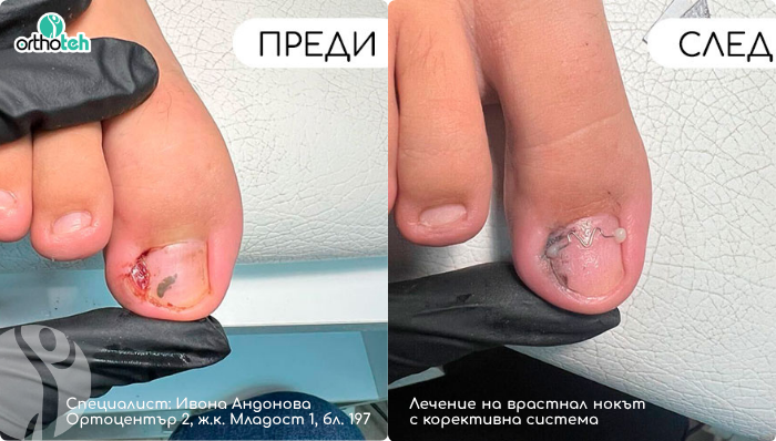 lechenie-na-vrastnal-nokat-s-konservativen-podhod-orthocenter2 Лечение на врастнал нокът с консервативен подход | Ортоцентър 2 | ОРТОТЕХ